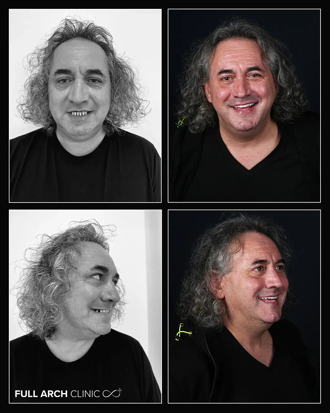 Before/after: transformarea după reabilitarea pe 12 implanturi — cazul domnului Solomon, Full Arch Clinic