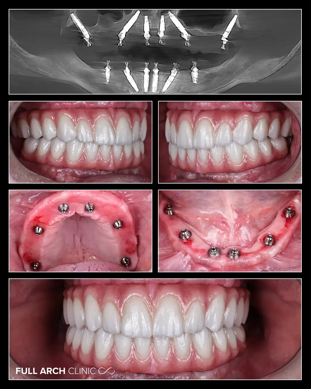 Cele 12 implanturi inserate, cu vindecare și țesut gingival sănătos — cazul domnului Solomon