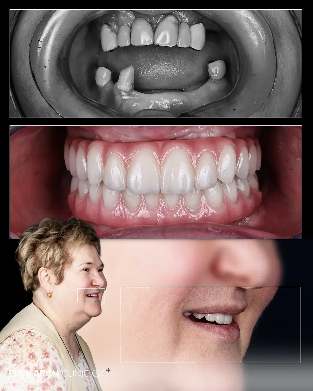 Imagine intraorală înainte și după tratament. Pacient avea o lucrare veche care menținea infecții la maxilar și 3 dinți restanți la mandibulă