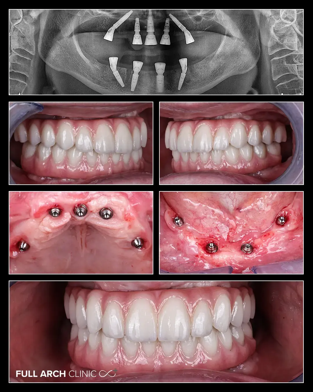 Colaj de imagini cu lucrările finale din zirconiu, vindecarea țesuturilor peri-implantare, și radiogafie OPT 1:1 de control la final de tratament