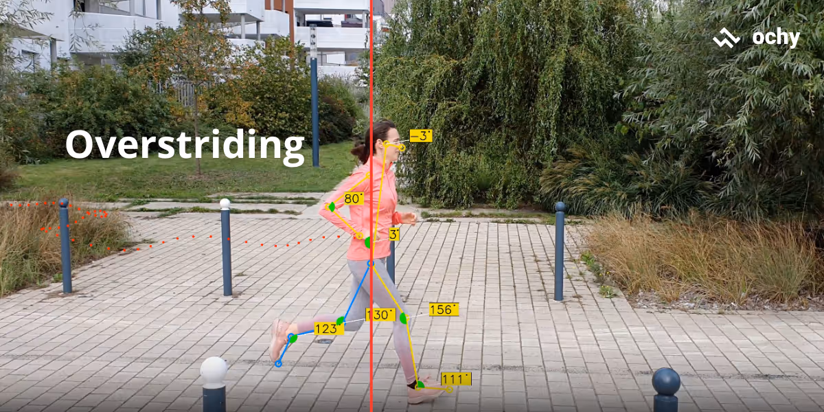 Overstriding when you run and lead to either anterior or medial shin splints