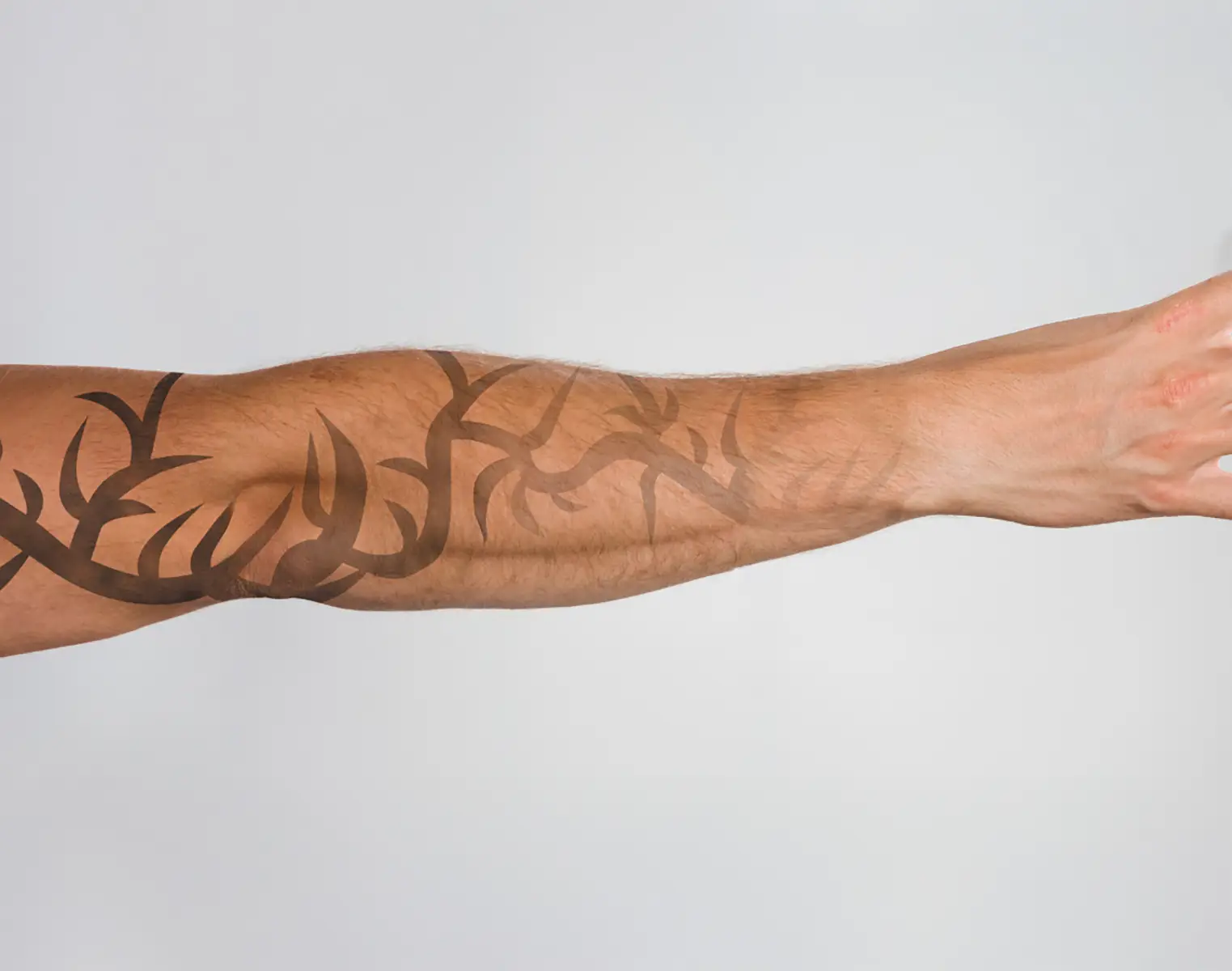 Northern Beaches Tattoo Removal