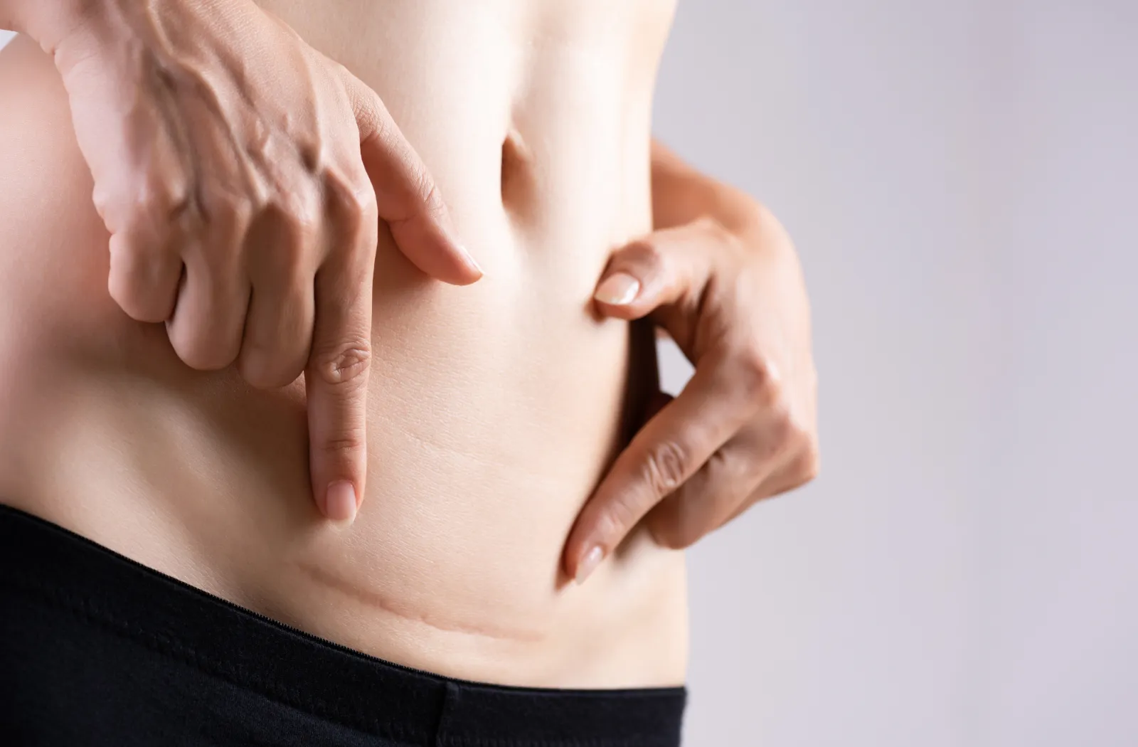 Close-up of a person pointing at a surgical scar on their abdomen.