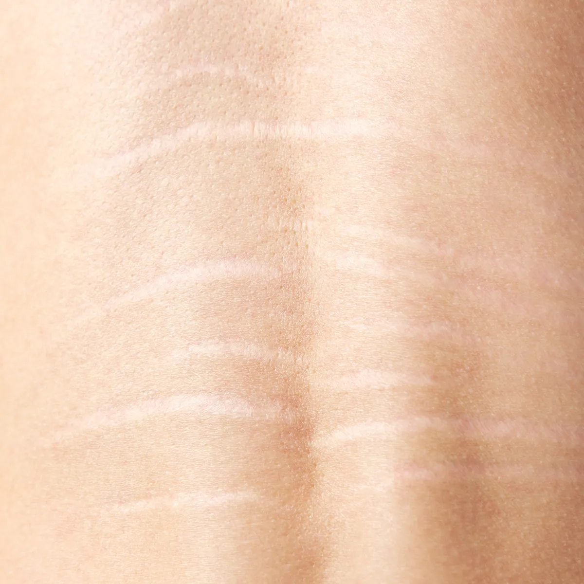 Close-up of skin with visible stretch marks.