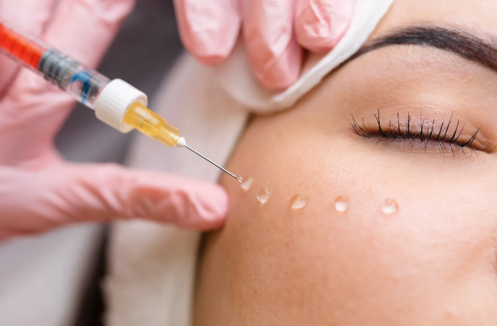 Injecting dermal filler into a patient's cheek.