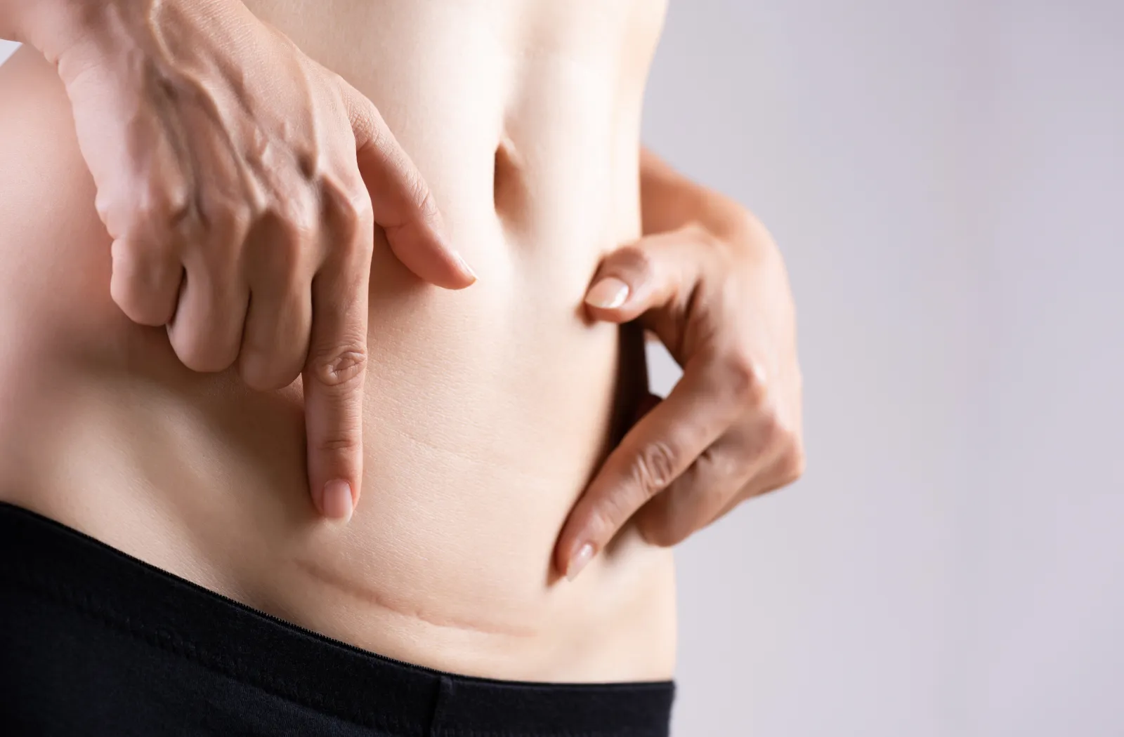 Woman pointing at stomach scar.