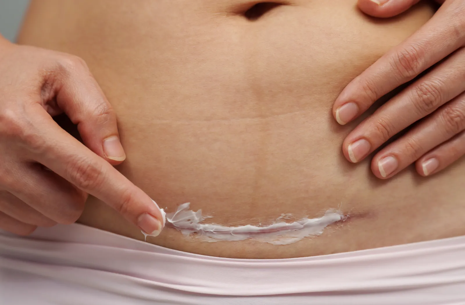 Applying cream to a healing C-section scar on the abdomen for postpartum care.