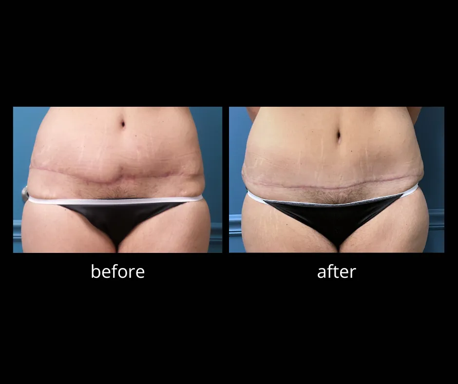 Before and after cosmetic surgery showing improved abdominal contour.