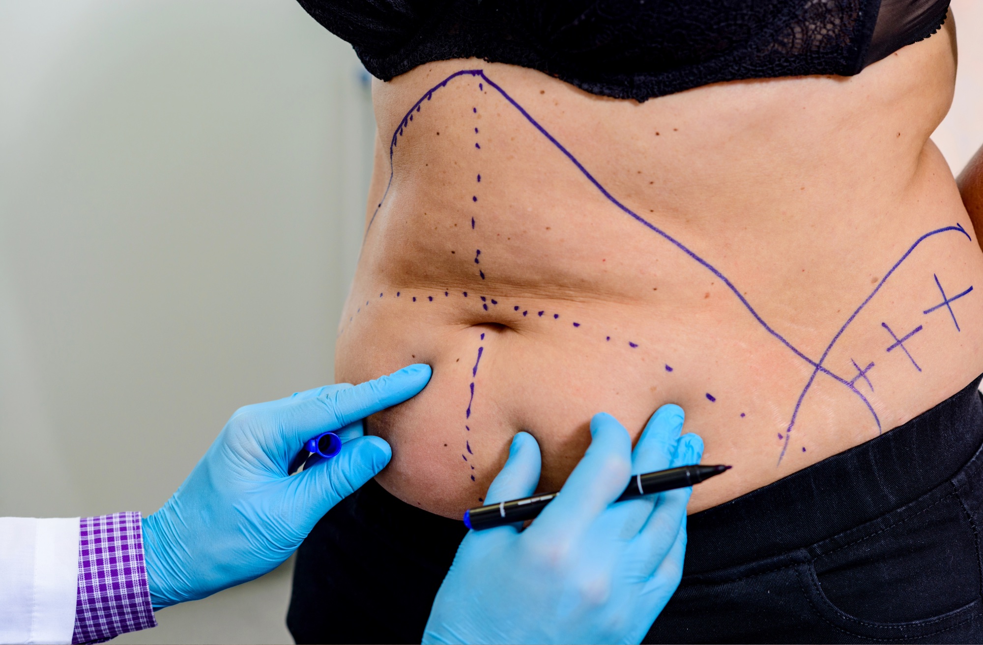 A close-up of a woman's bare midsection with hands in blue medical gloves gently holding her abdomen, suggesting a cosmetic or medical procedure like liposuction. The background is neutral and clinical.
