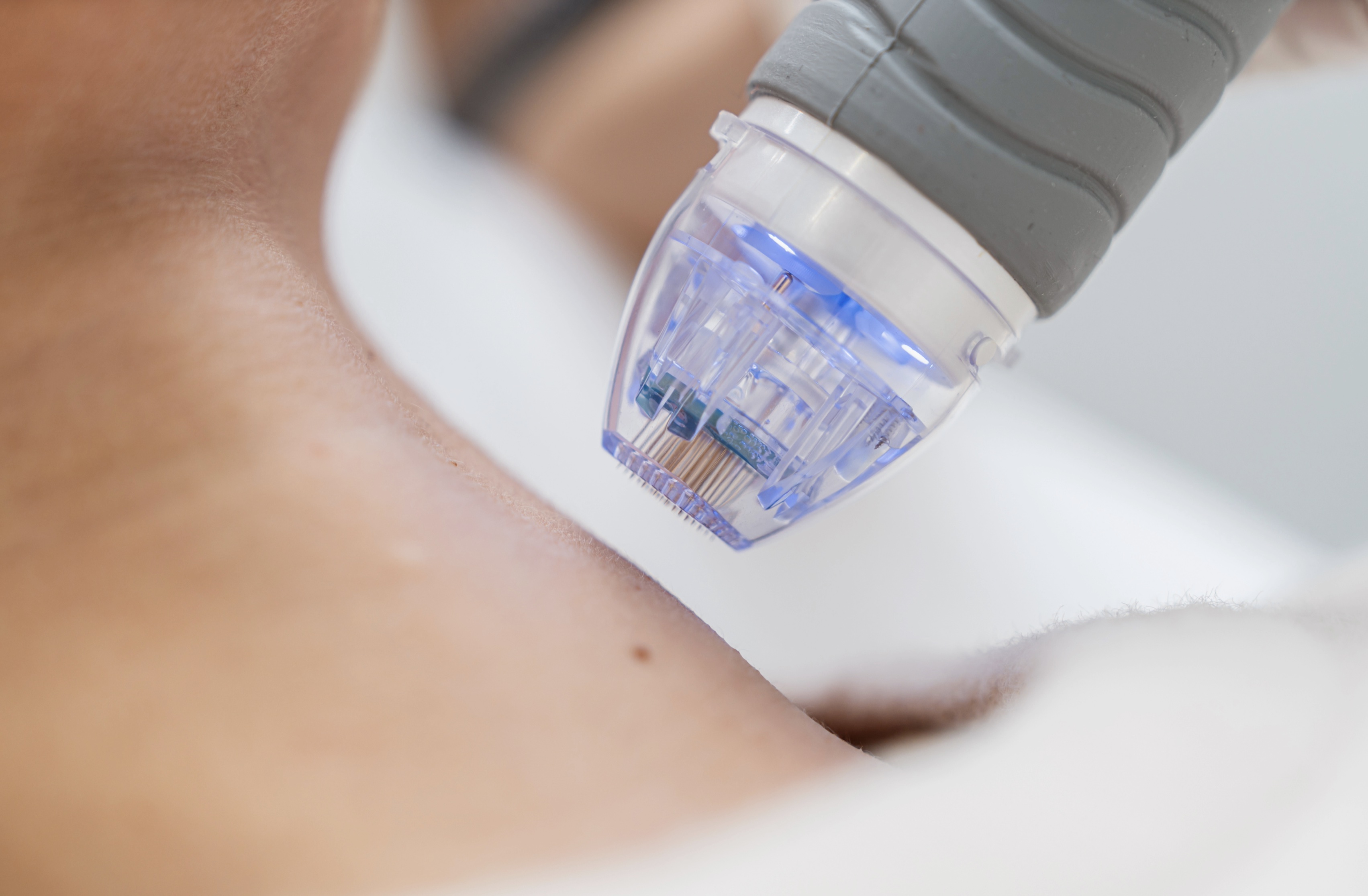Close-up of a microneedling device treating skin, focusing on precision cosmetic skincare procedure.