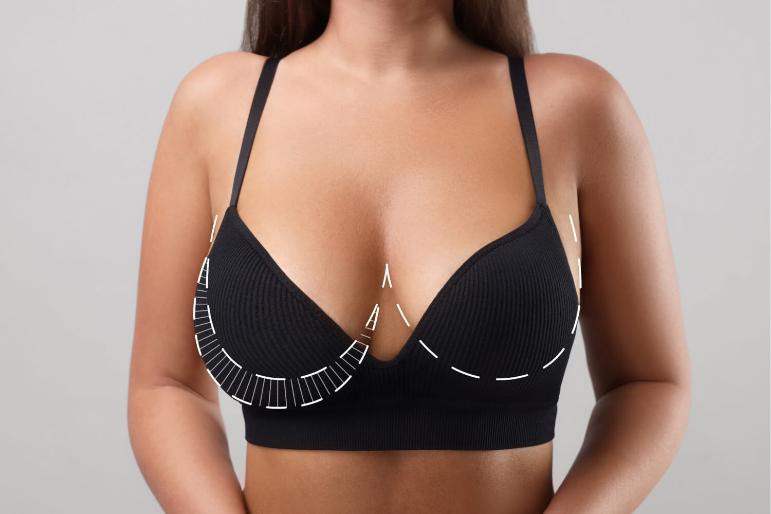 Woman wearing a black bra with white dotted surgical lines drawn on her chest and under her breasts, indicating areas commonly targeted in breast reduction surgery.
