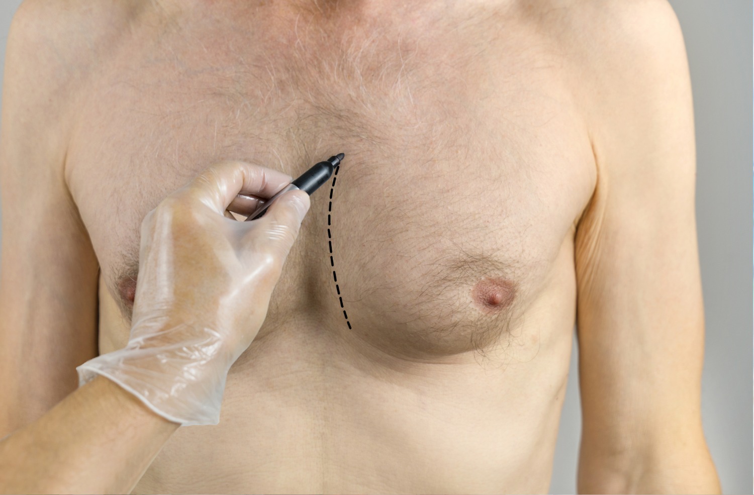 Hand with a disposable glove marking a curved line on a man's bare chest with a black marker.