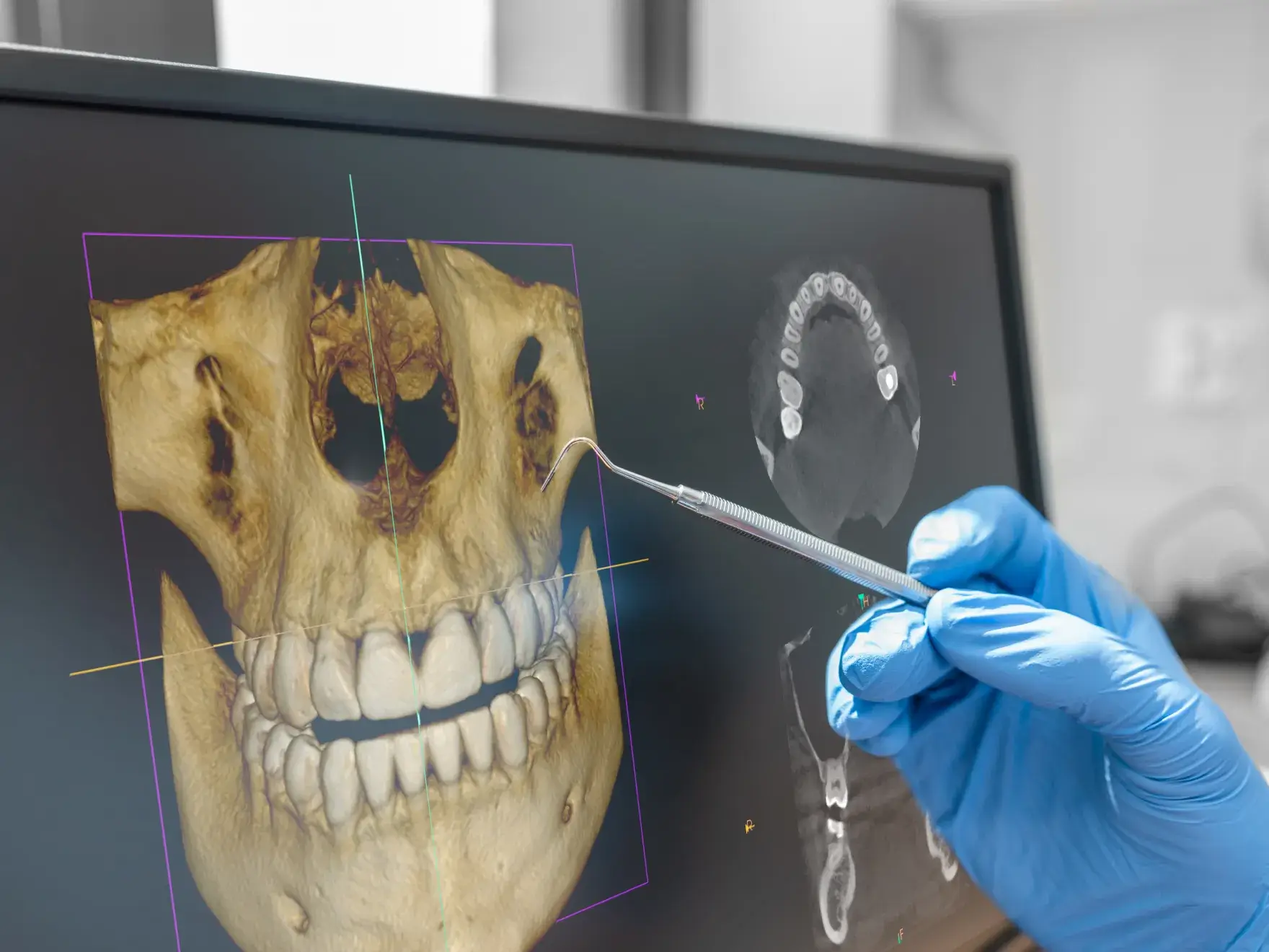 Gloved hand holding a dental explorer pointing at a 3D digital dental scan on a computer monitor.