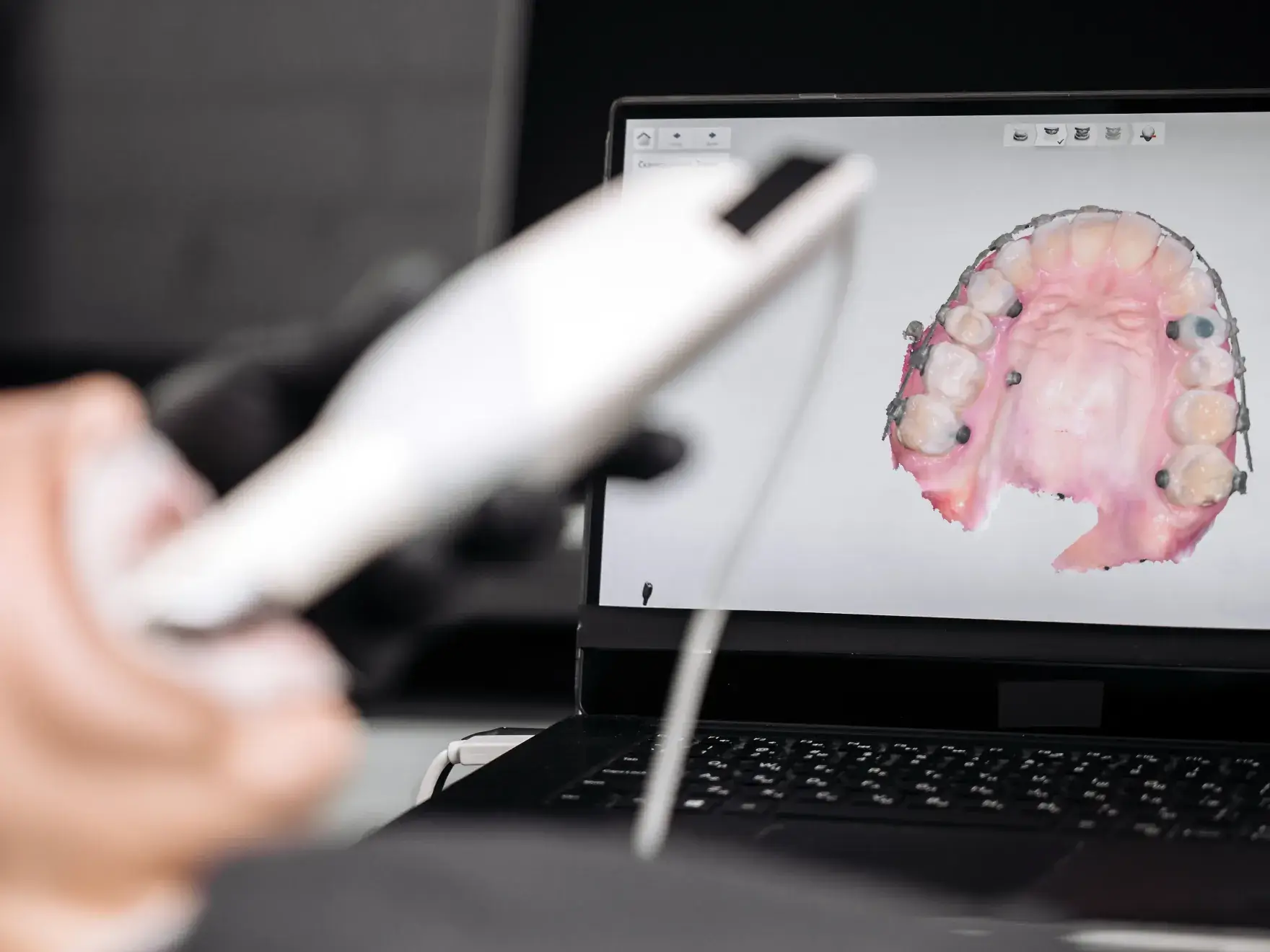 Dental professional holding an intraoral scanner with a 3D digital model of upper teeth displayed on a laptop screen.