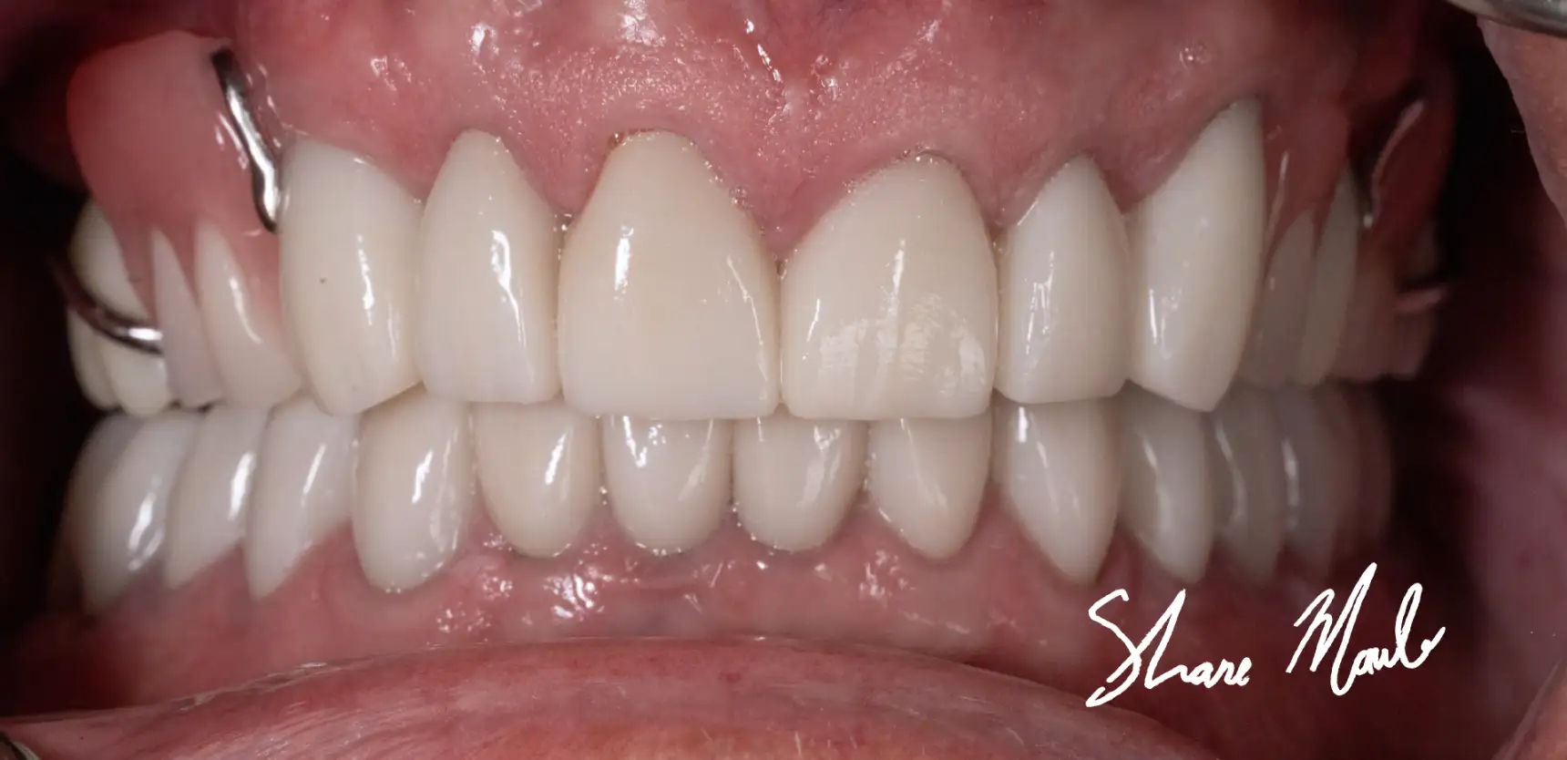 After treatment