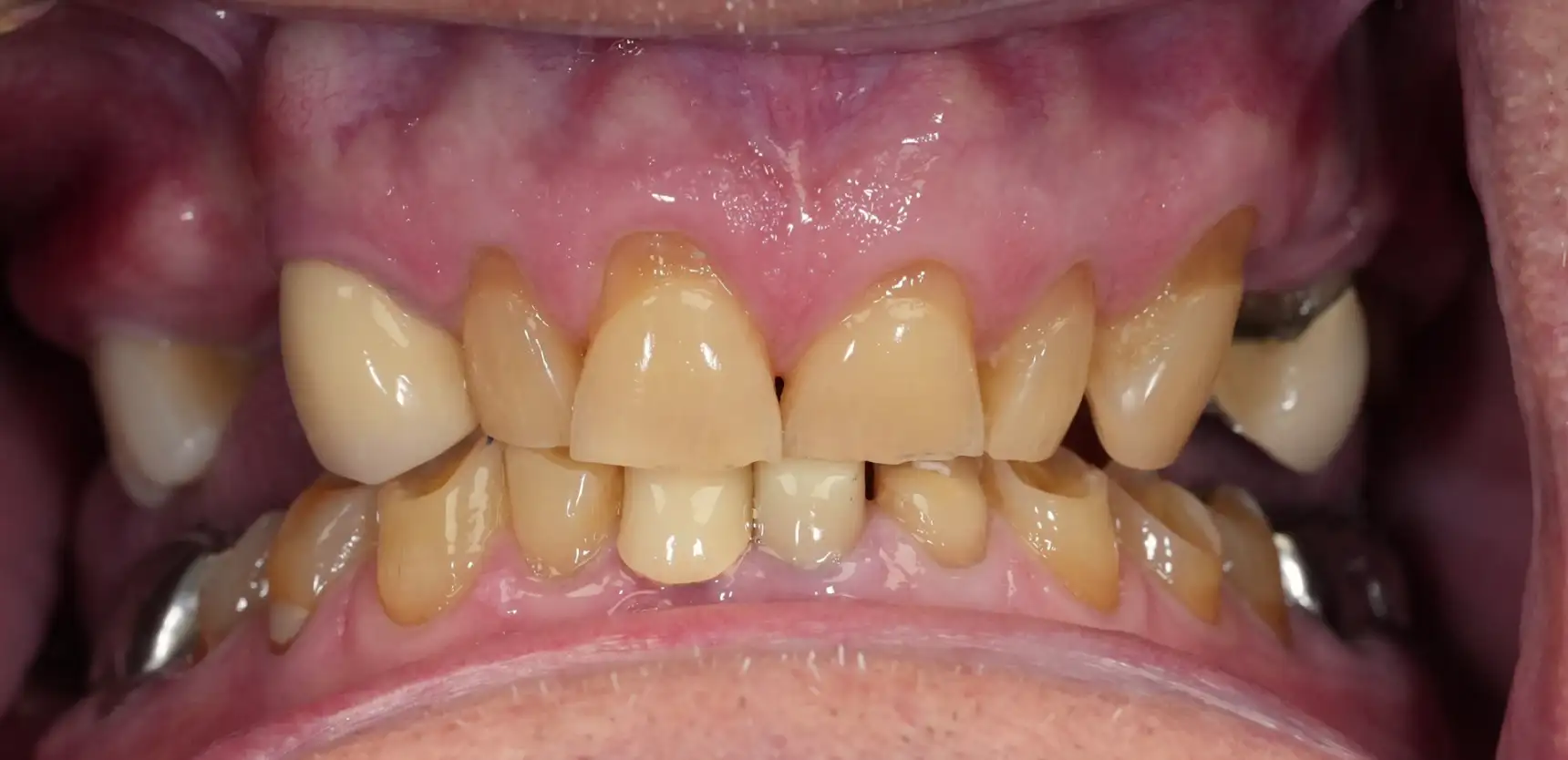 Before treatment