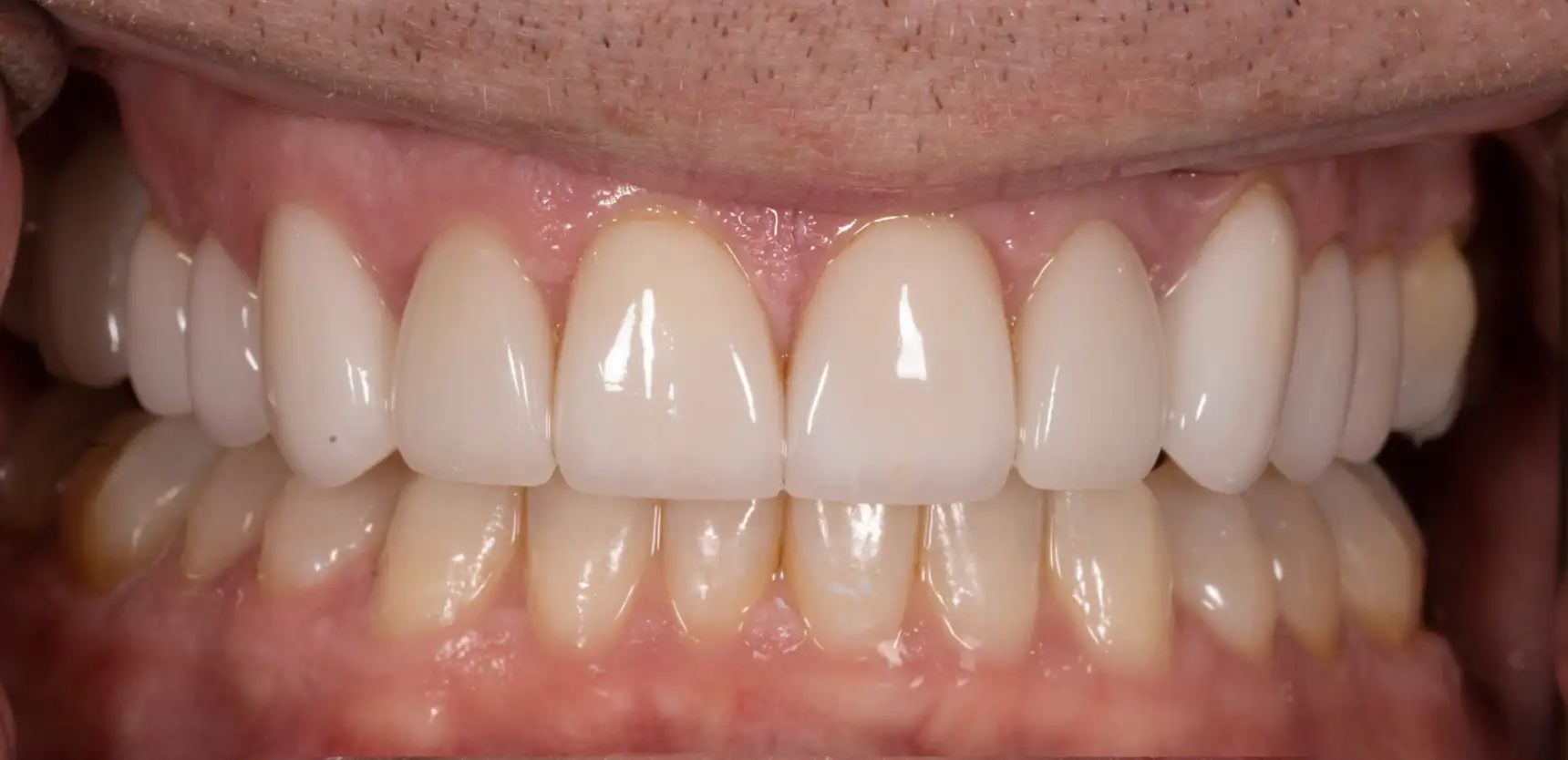 Before treatment