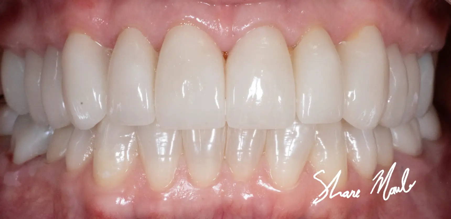 After treatment