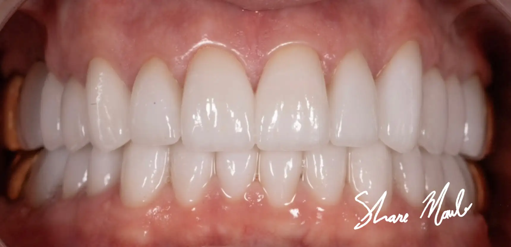 After treatment