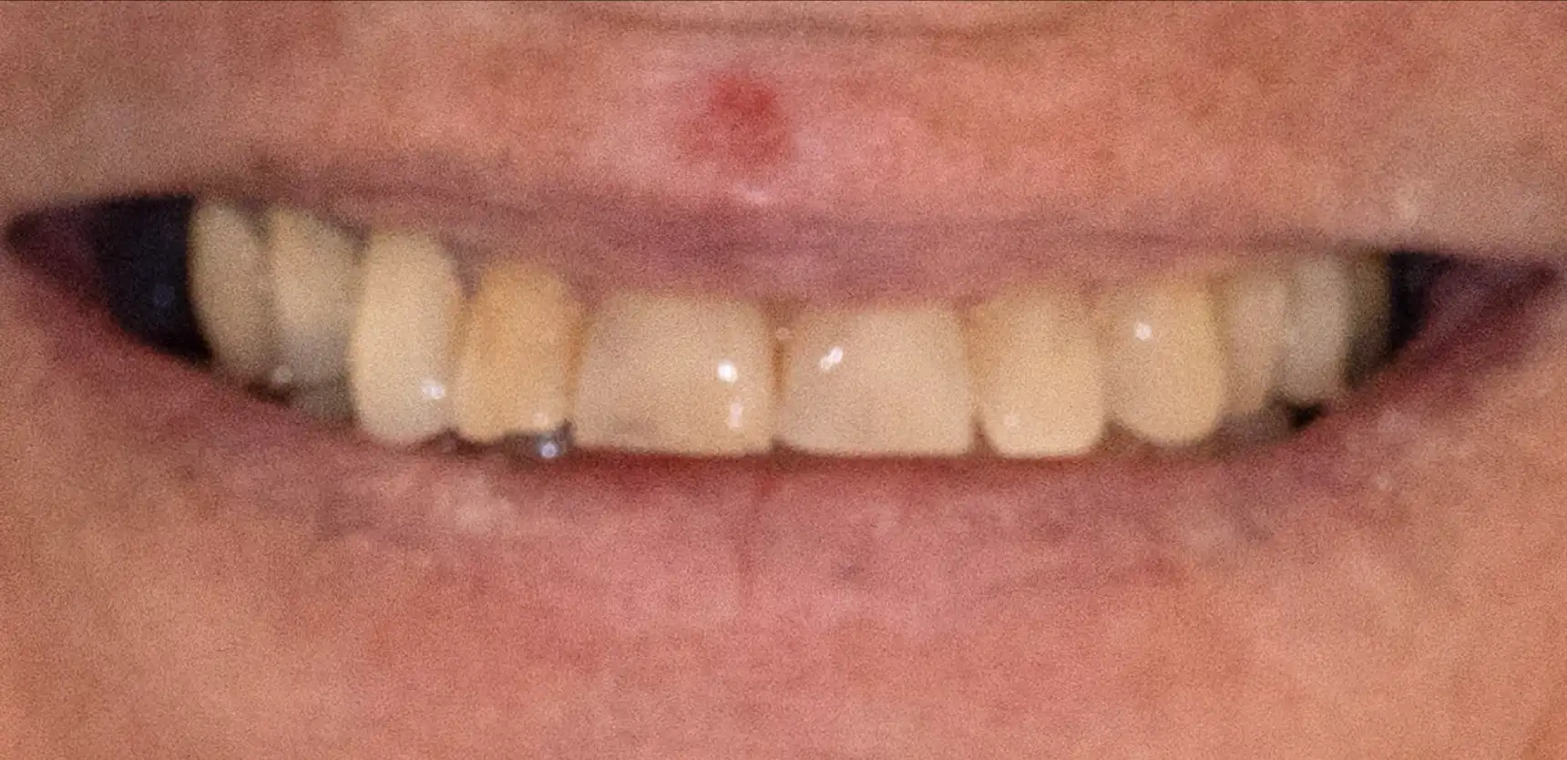 Before treatment