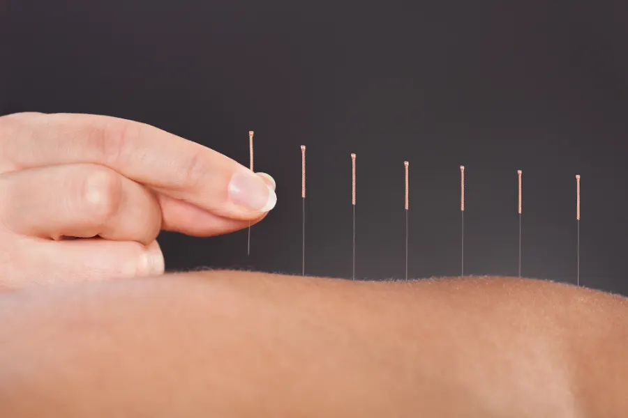Acupuncture needles placed along the back