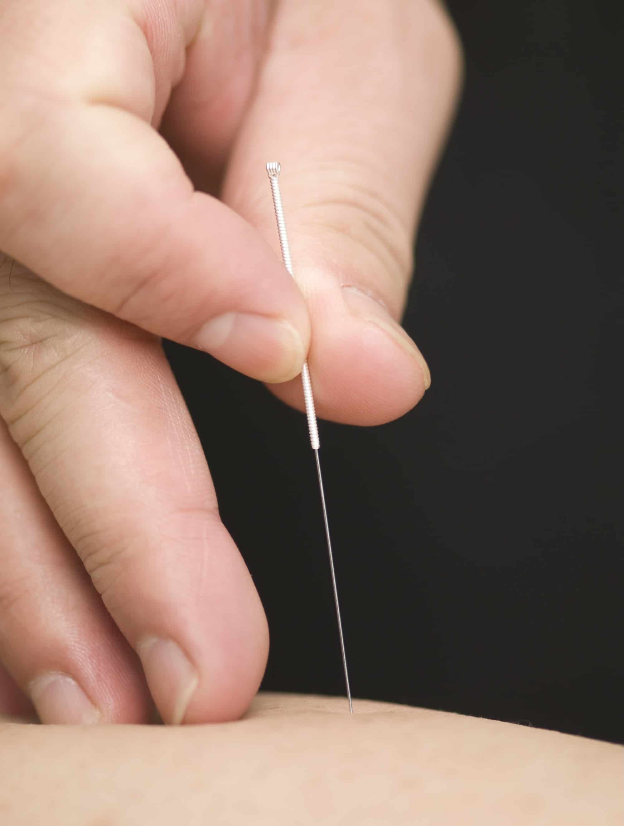 Hand die een fijne naald vasthoudt die in huid wordt ingebracht tijdens acupunctuurbehandeling.