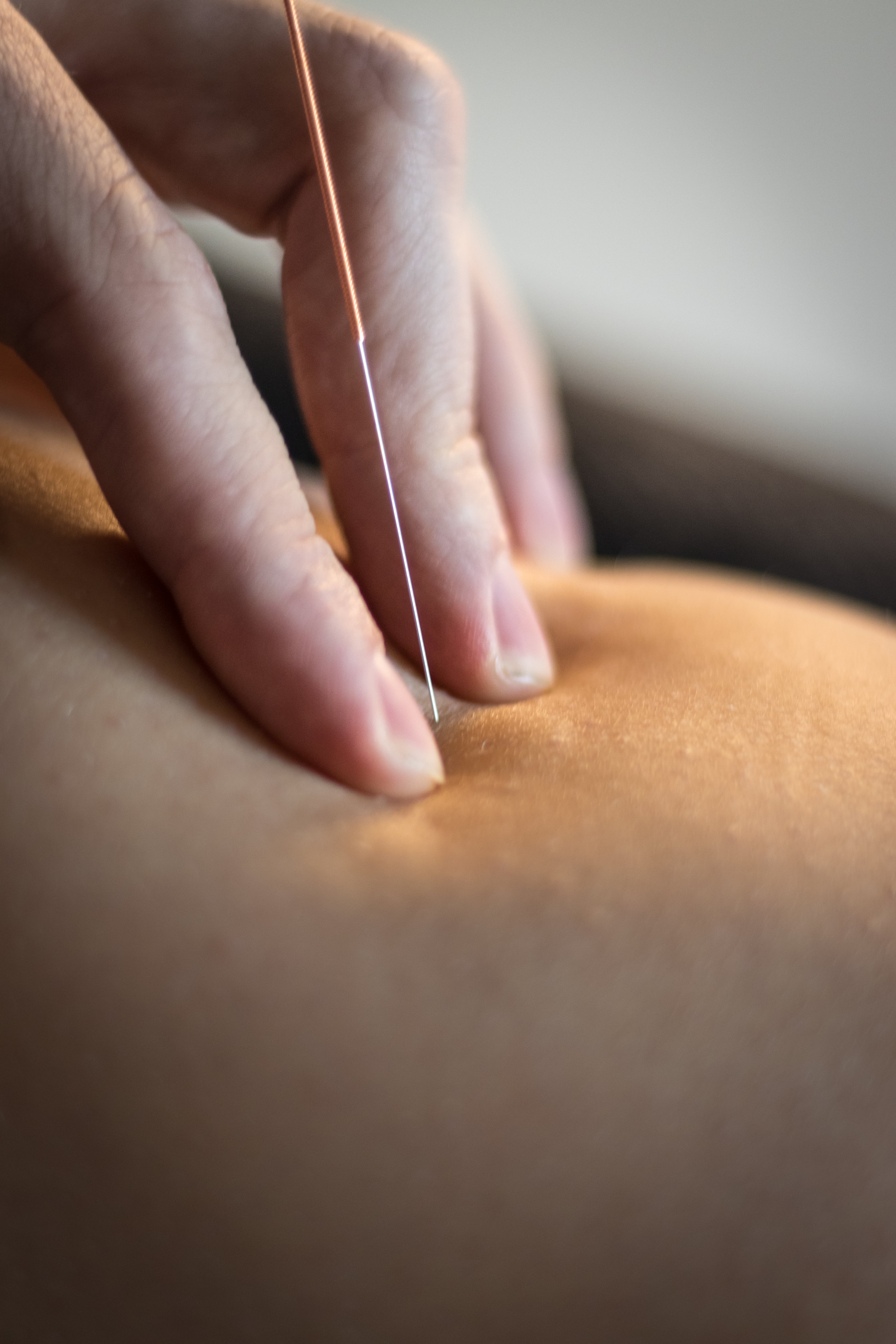 Hand inserting an acupuncture needle into the skin during treatment.