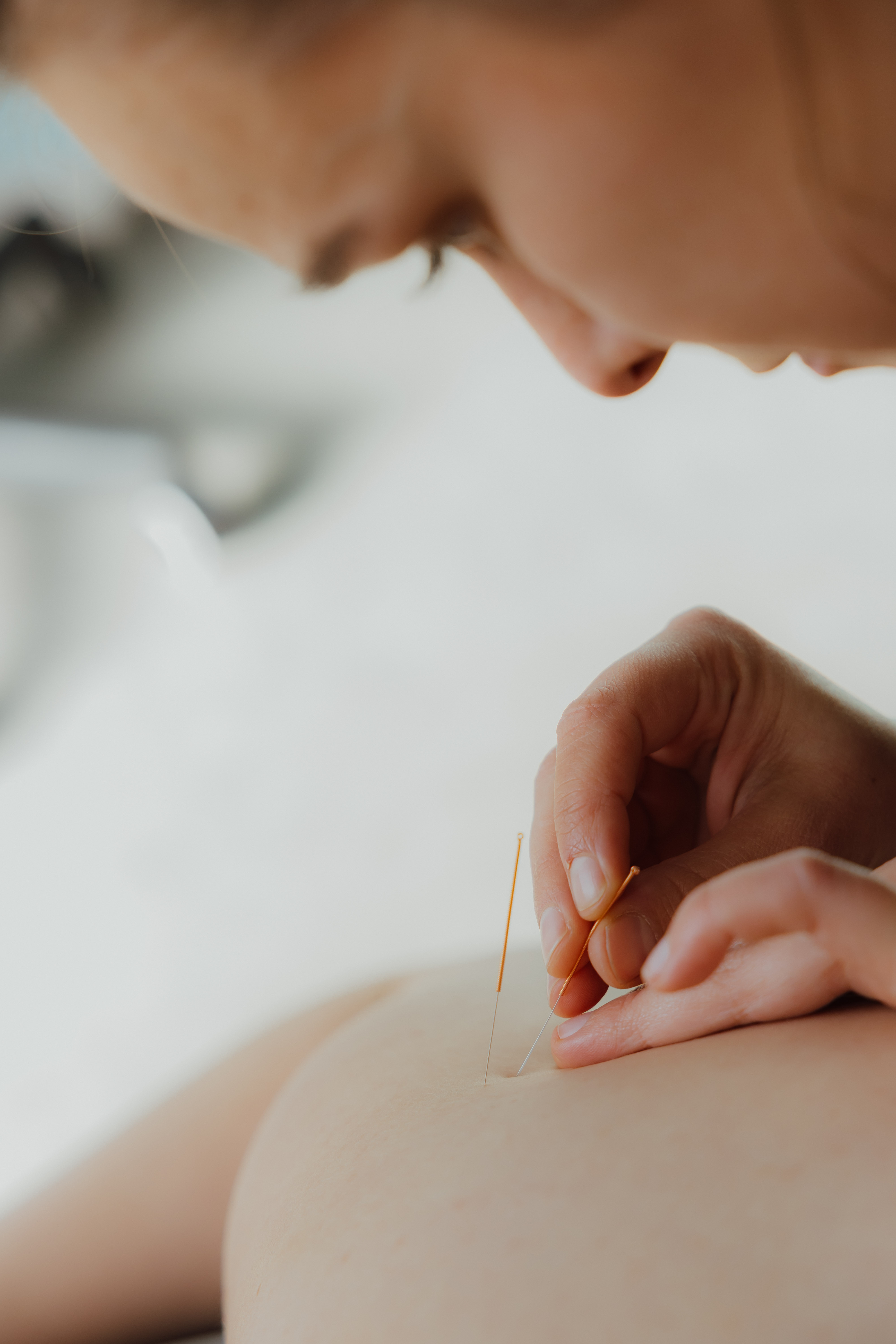 Close-up van een persoon die naalden in de huid plaatst voor acupunctuurbehandeling.