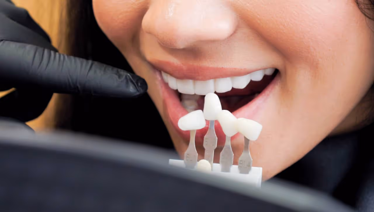 shade match patients teeth tooth for veneers