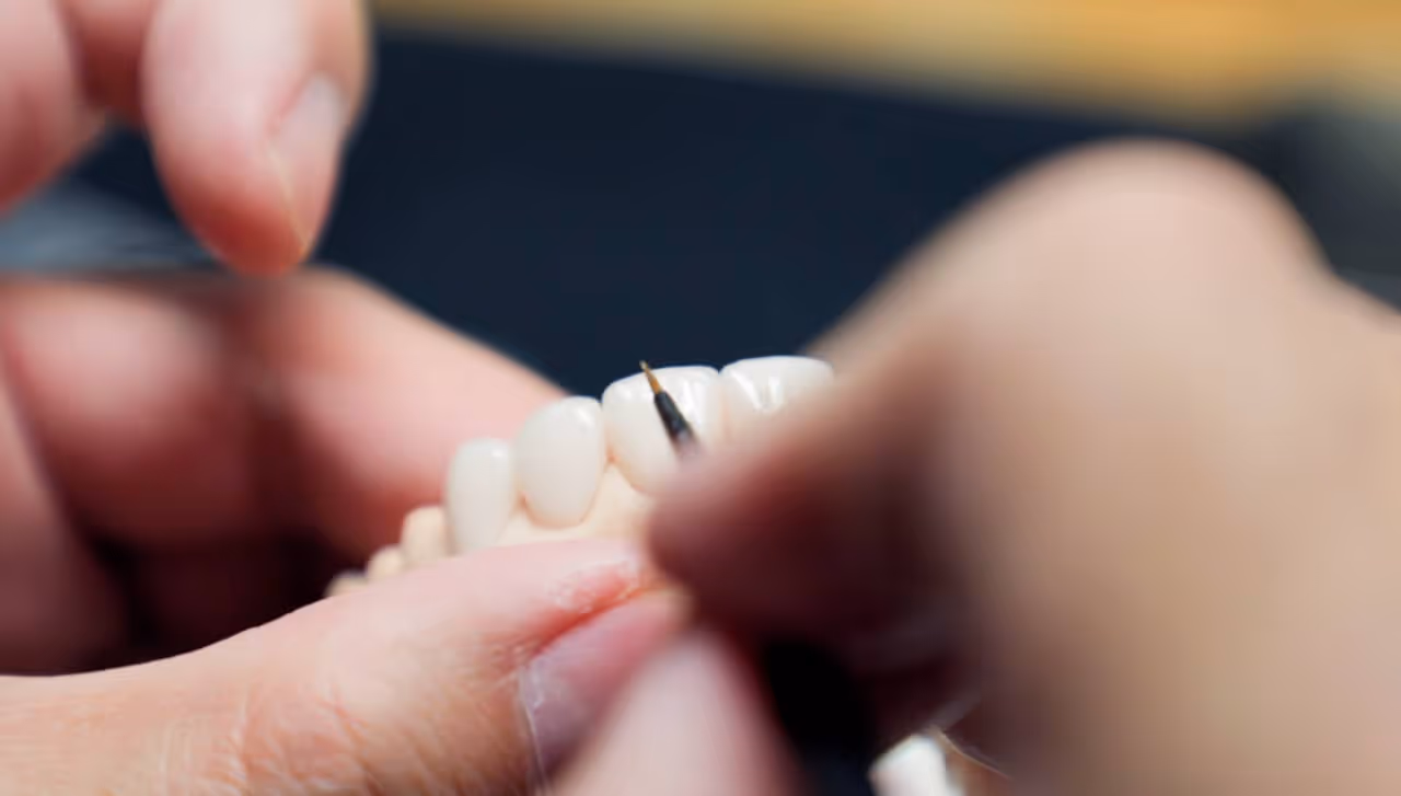 colouring veneers to shade match