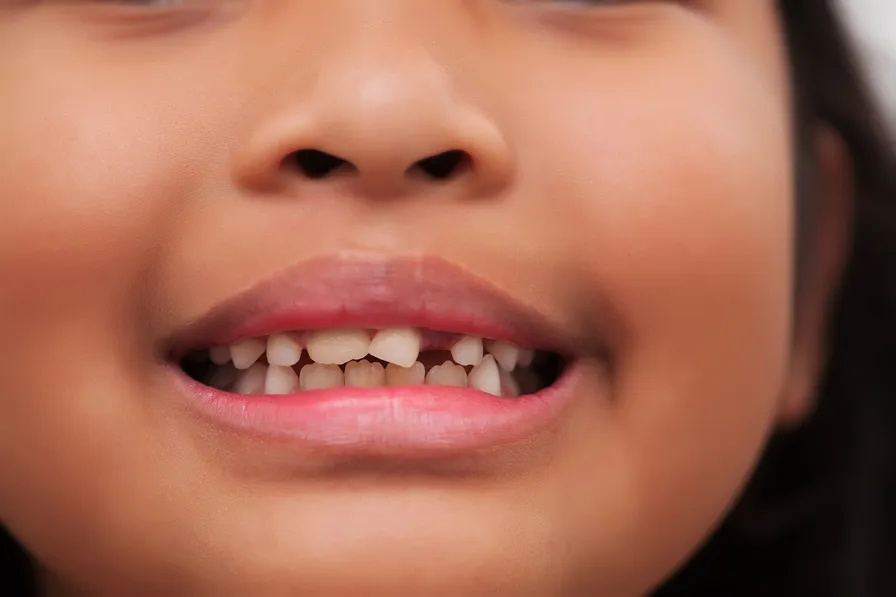 Child crooked missing teeth tooth