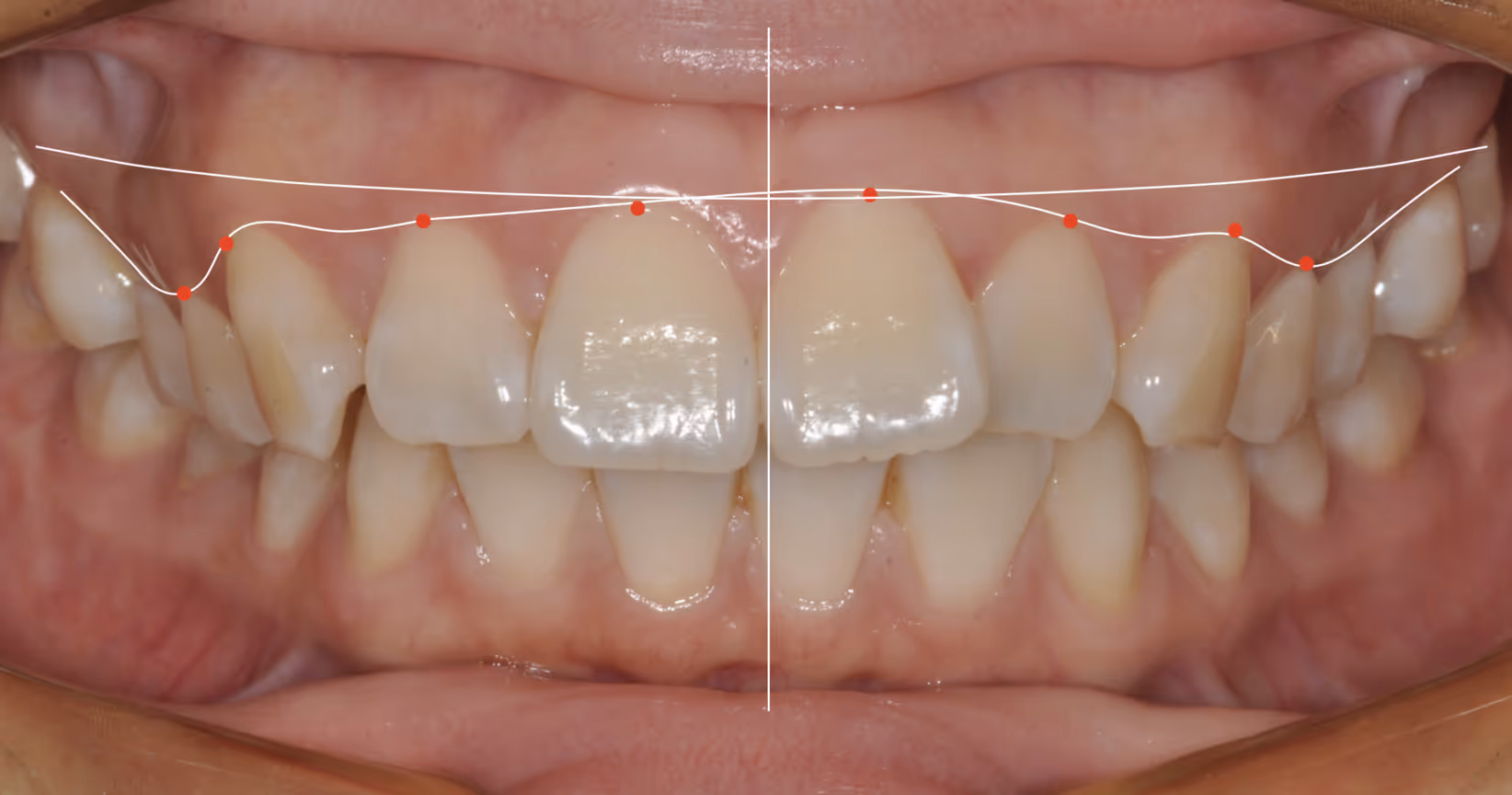 Close-up of upper front teeth with dental analysis lines and red dots marking the gum line and tooth contours.