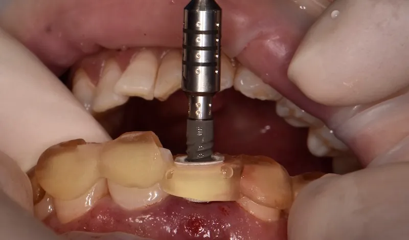 Close-up of a dental surgical guide in a patient's mouth during an implant procedure with a dental drill positioned in the guide.