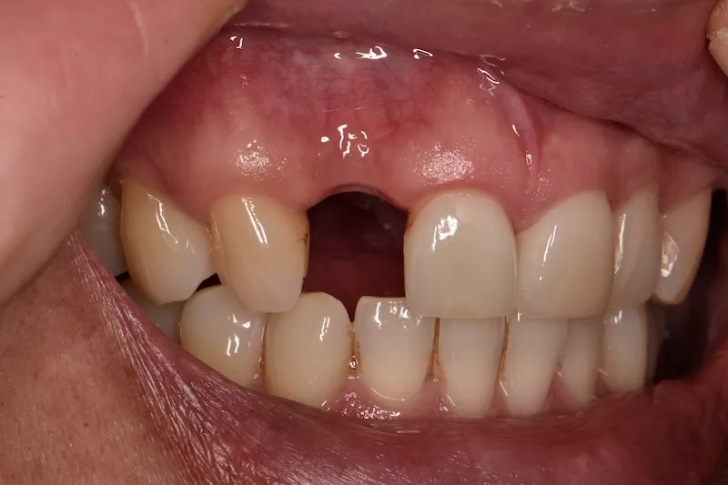 Close-up of a person's mouth showing missing upper front tooth and surrounding natural teeth.