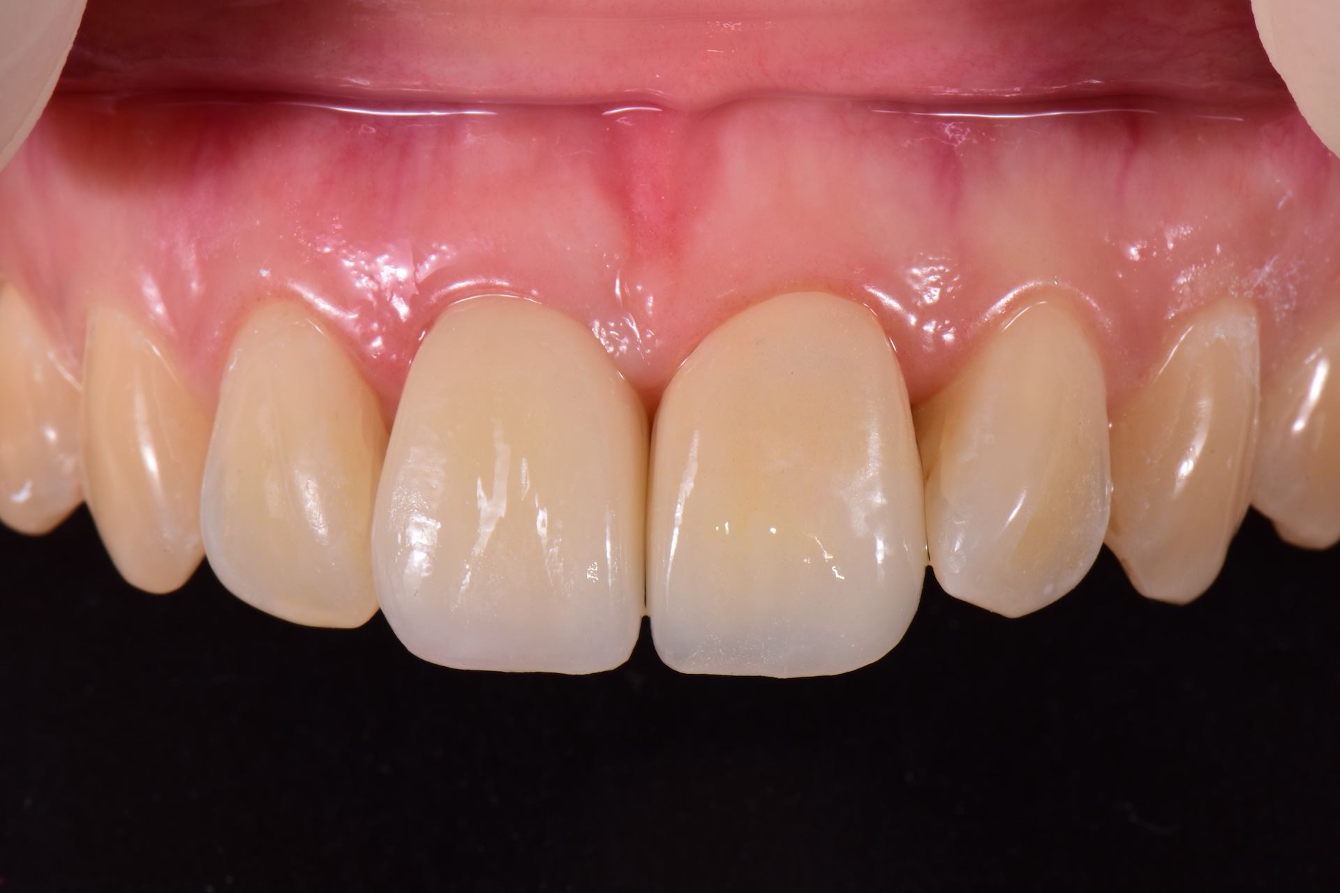 Close-up of a dental implant with a metal screw inserted into the jawbone and a white crown on top, surrounded by natural teeth and gums.