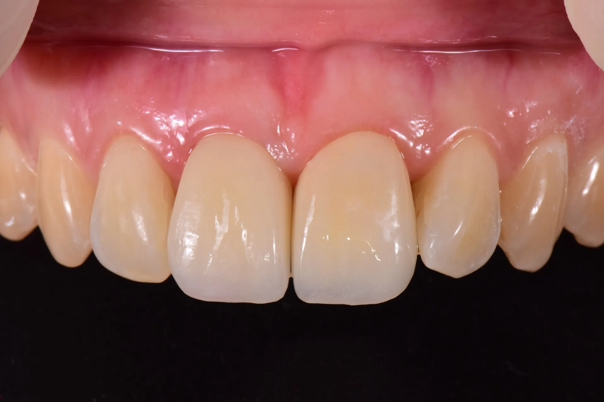 Close-up of a dental implant with a metal screw inserted into the jawbone and a white crown on top, surrounded by natural teeth and gums.