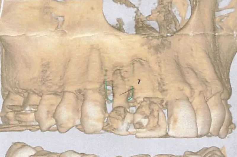 3D dental scan showing upper teeth and jaw structure with a focus on a specific tooth marked with the number 7.