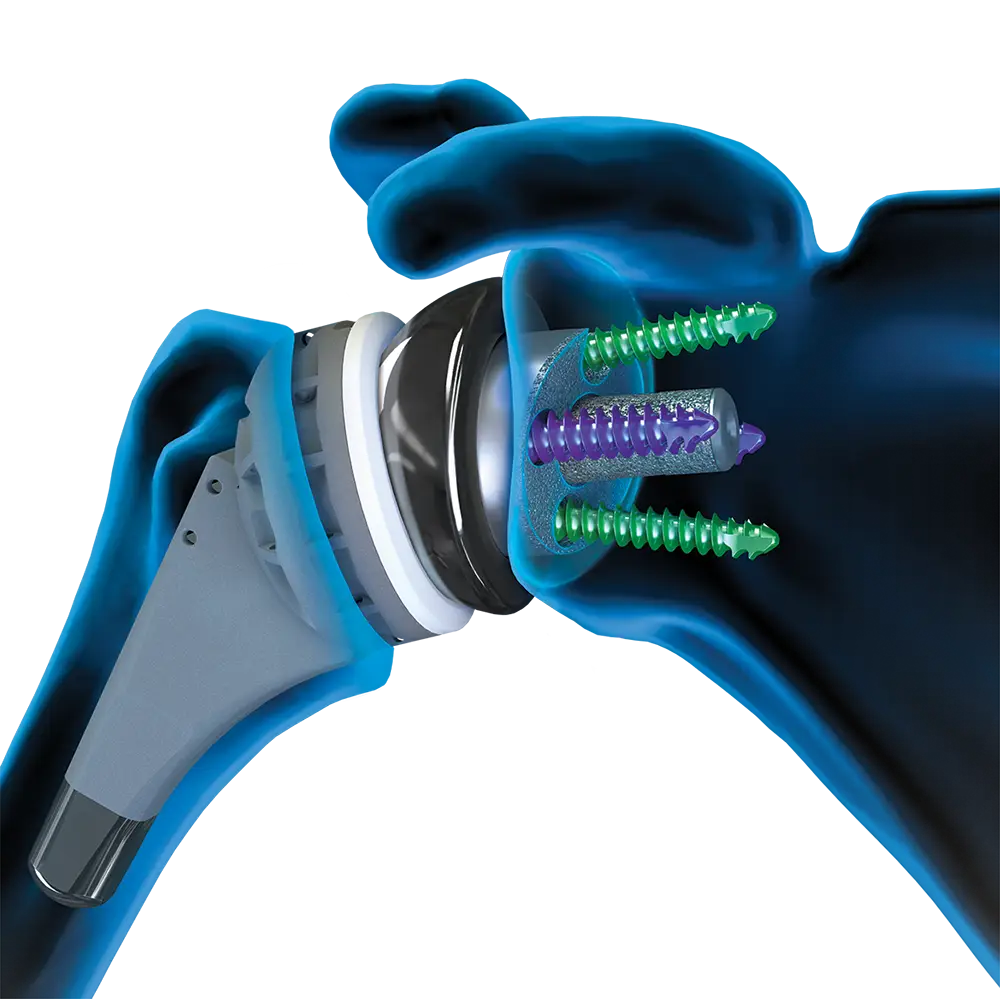 Close-up of Univers Revers™ shoulder arthroplasty system, shoulder prosthesis for reverse total shoulder replacement surgery, including glenoid and screws.
