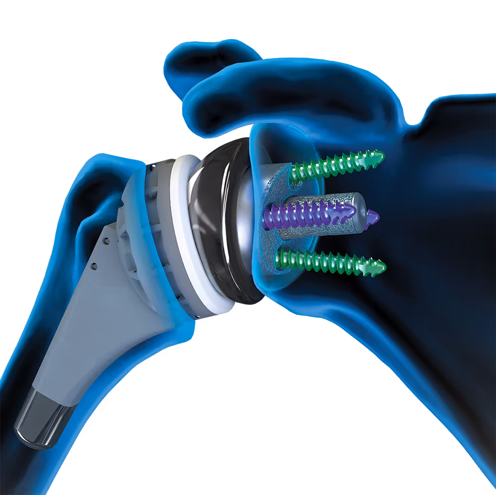 Close-up of Univers Revers™ shoulder arthroplasty system, shoulder prosthesis for reverse total shoulder replacement surgery, including glenoid and screws.