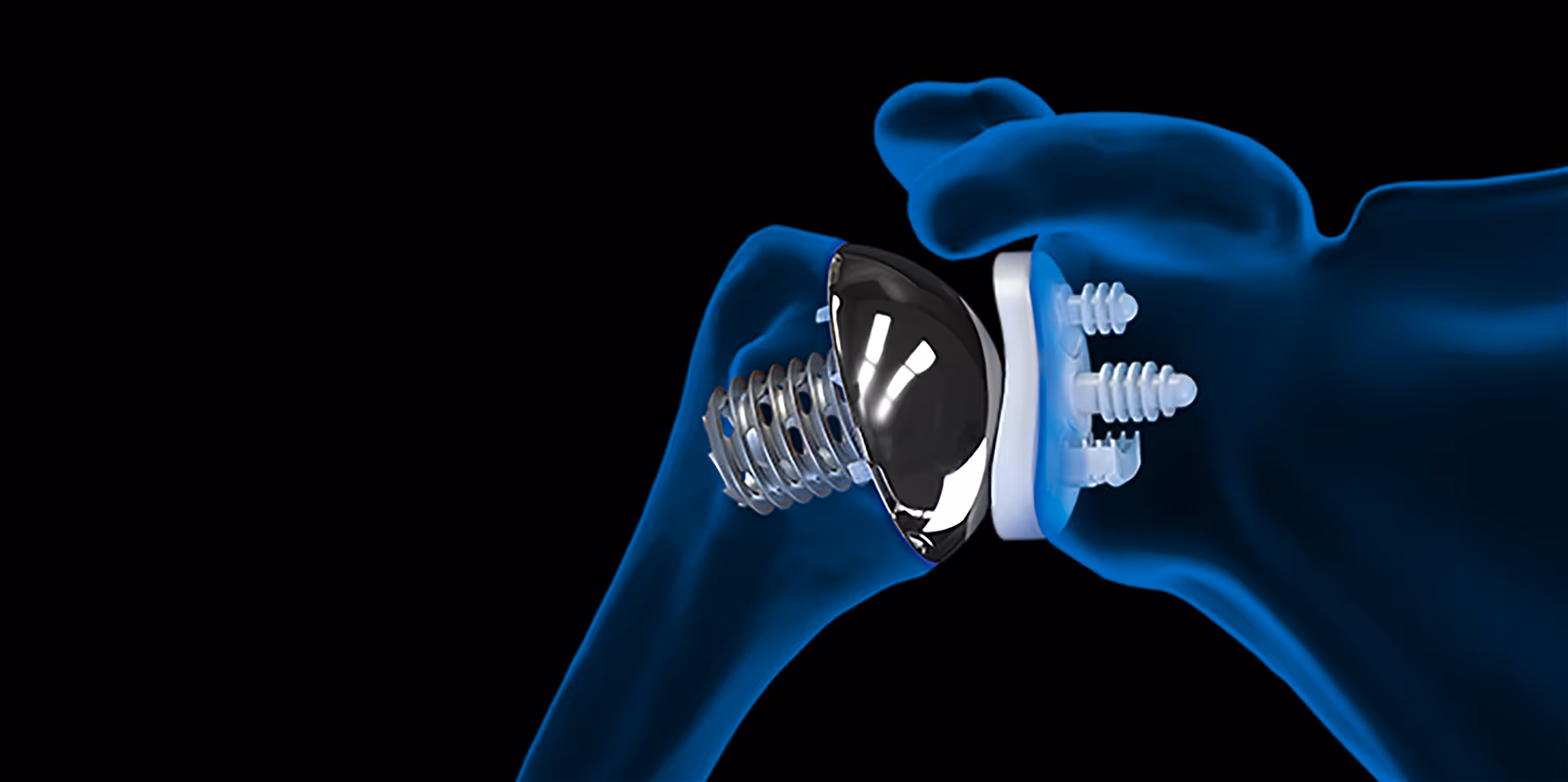 Arthrex Eclipse™ total shoulder system showing humeral head implant and glenoid implant.