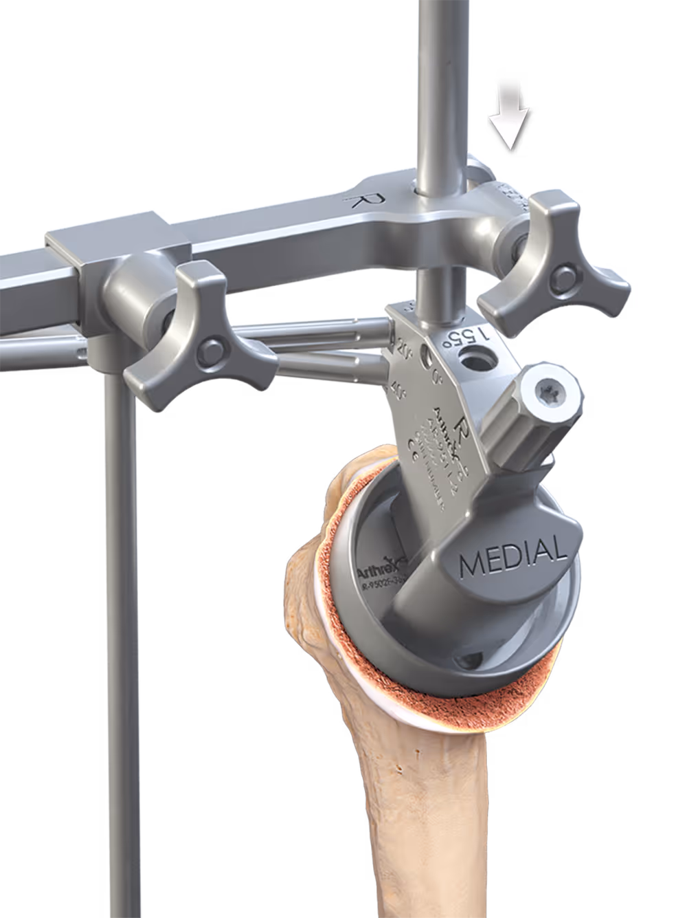 Impactor/extractor handle threaded into proximal hole of the adapter in the humerus.