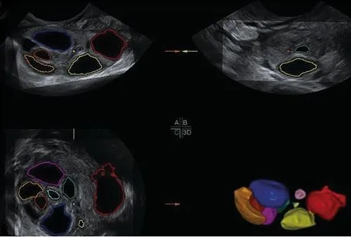 Follicle Tracking & AFC Scan