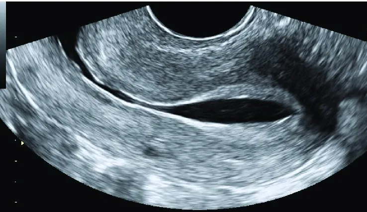 Saline Infusion Sonography (SIS)