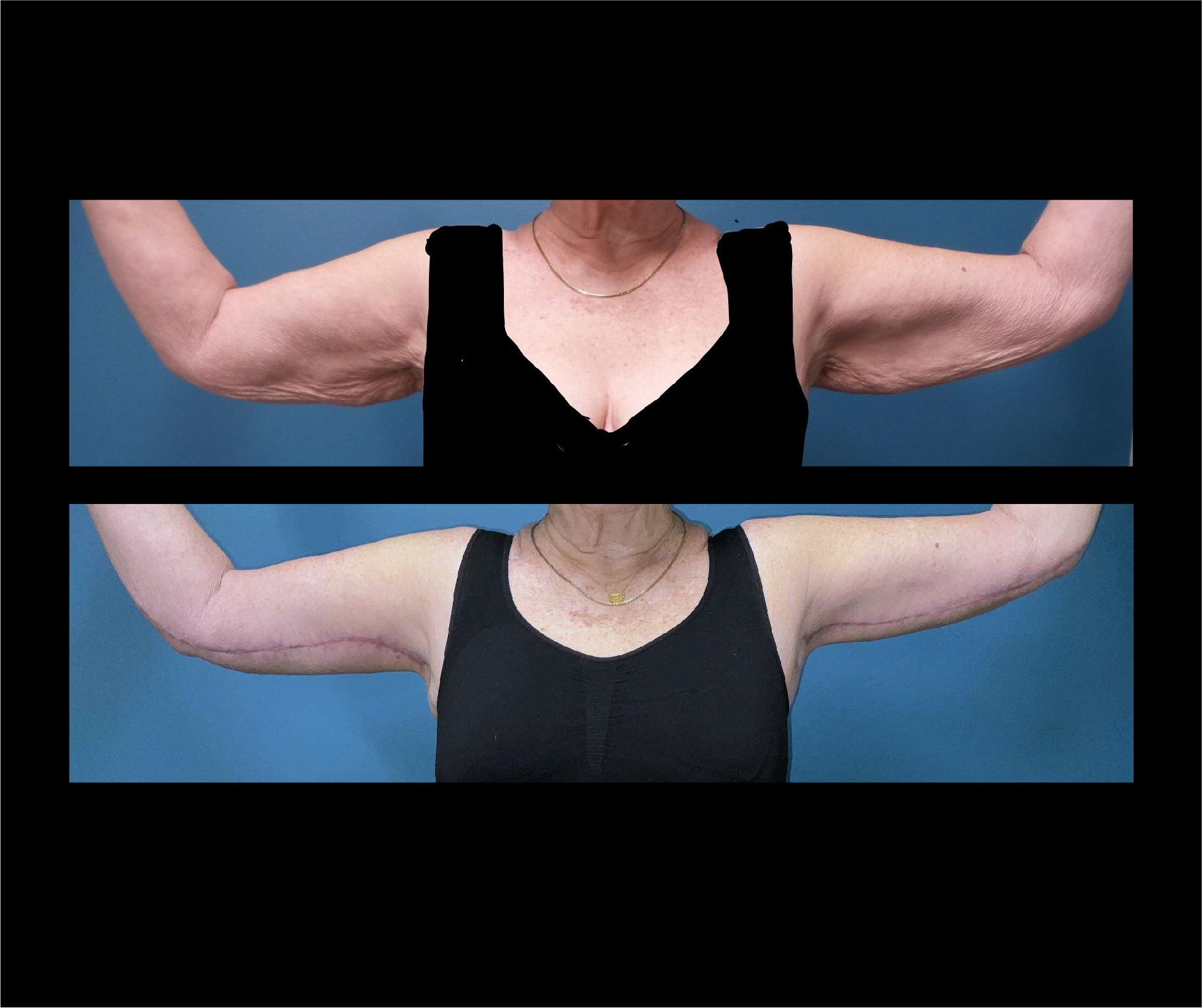 Patient A - Upper Arm Lift Front