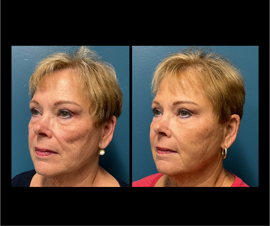 Patient A Fat Grafting To Cheek Hollow