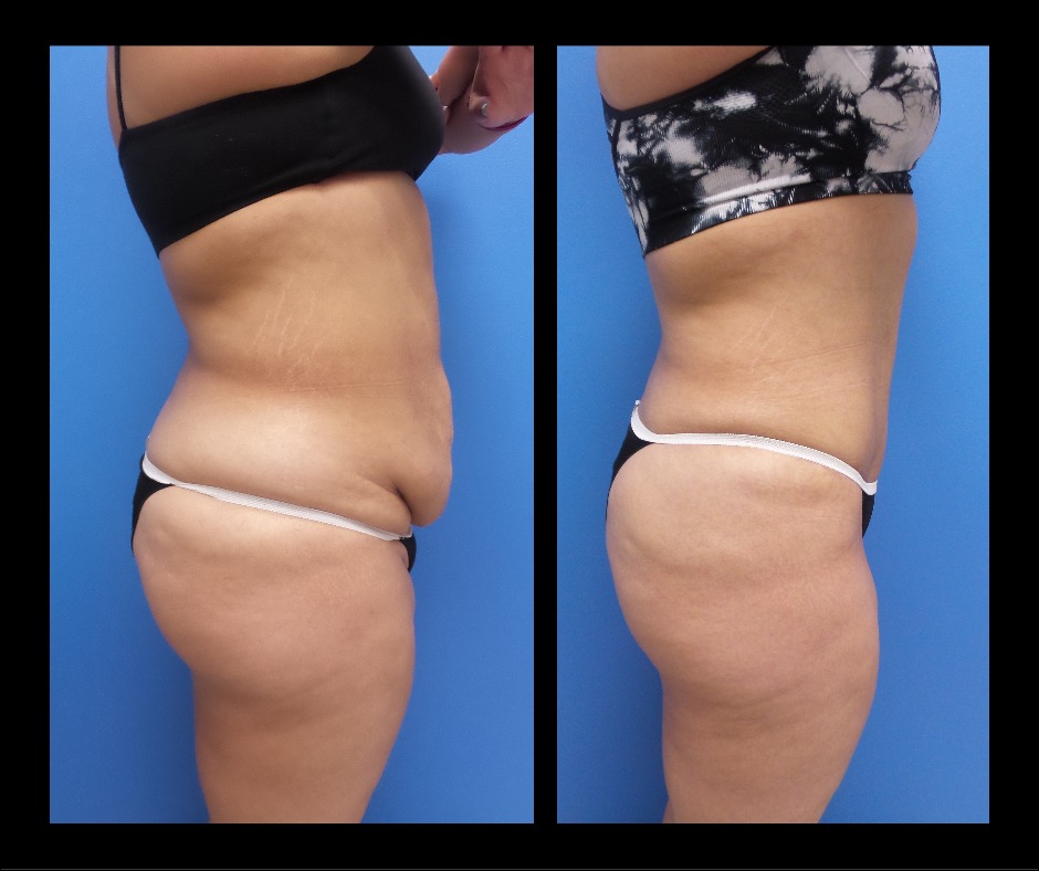 Patient Q Tummy Tuck No Lipo