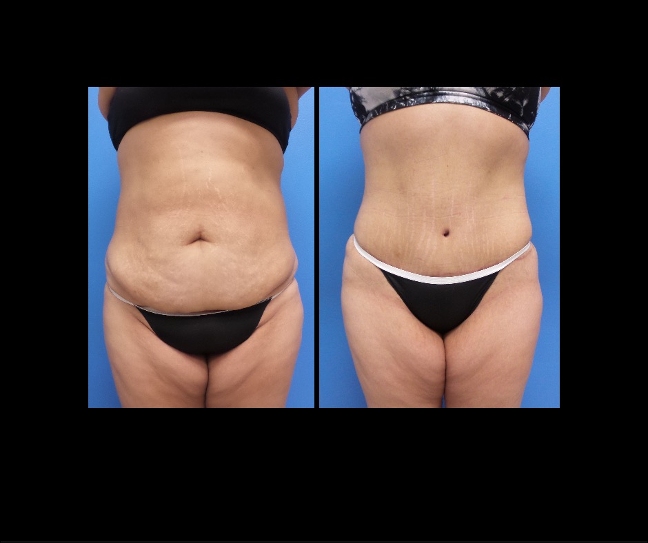 Patient Q Tummy Tuck No Lipo Front