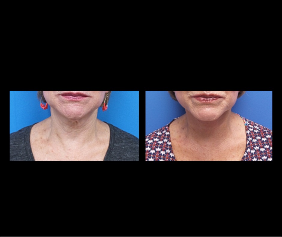 Patient A Neck Lift
