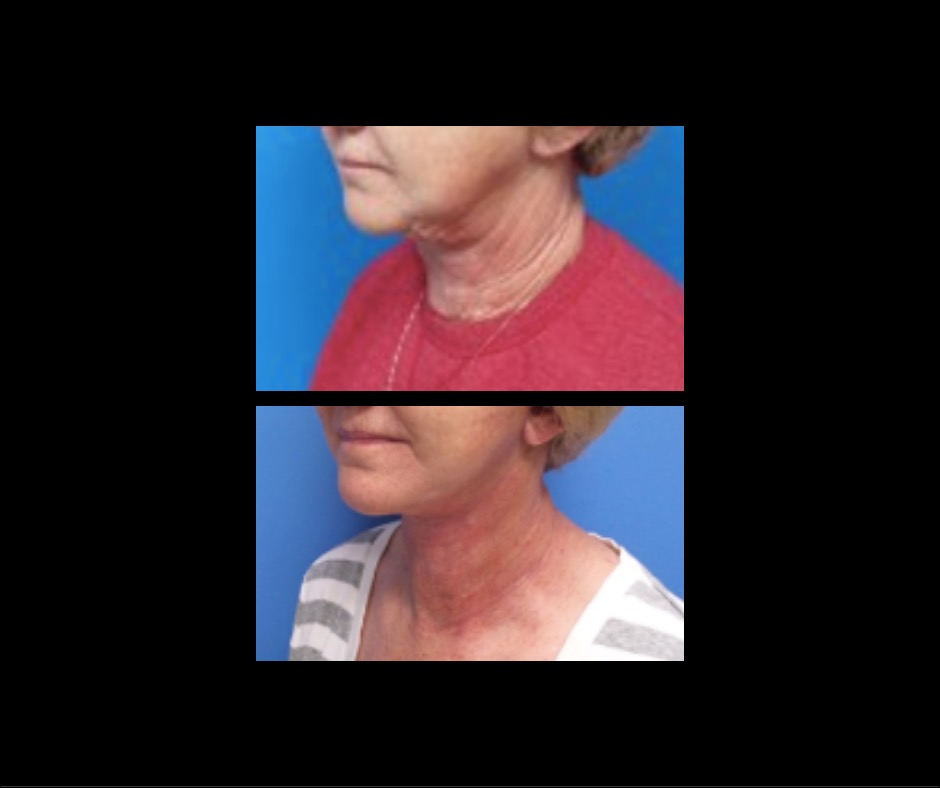 Patient B Neck Lift