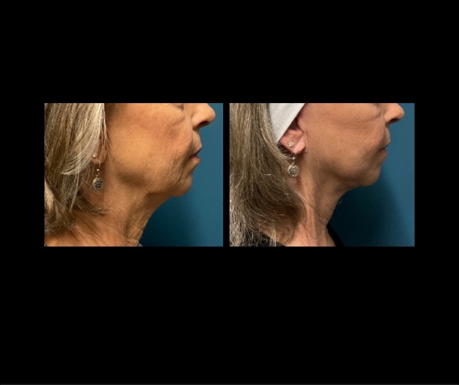 Patient D Neck Lift